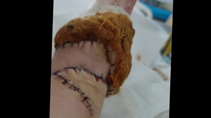 هذا المظهر تحقق بعد زراعة الجلد عدة مرات وكلفني أكثر من 30، لكنه جيد جدًا بالنسبة لي.