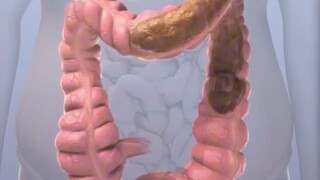 The reason why most people often experience constipation
