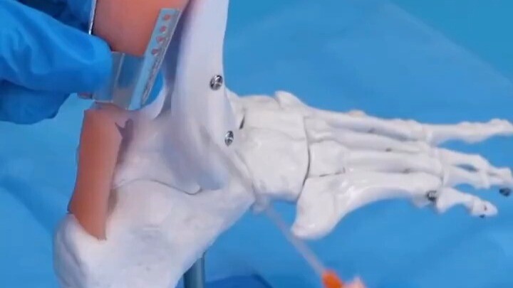 手把手教你修复跟腱断裂