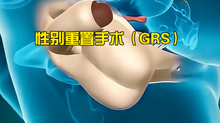 جراحة إعادة تحديد الجنس (GRS): كيف يتحول الصبي إلى فتاة؟