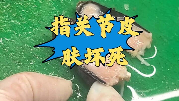 Medical科普—Viewer discretion advised! Skin ulcers and necrosis are commonly seen in diabetic complica