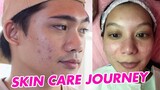 PAANO MAWALA ANG PIMPLES? | DISCOVER FLAWLESS SKIN CARE JOURNEY