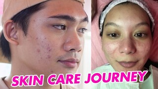 PAANO MAWALA ANG PIMPLES? | DISCOVER FLAWLESS SKIN CARE JOURNEY