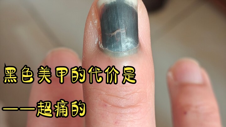Time is the best healer—changes over six months after a finger was caught in a car door