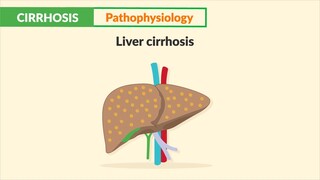 Cirrhosis