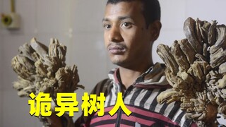 诡异的树人：外国小伙四肢长出树杈，难道是变异了？