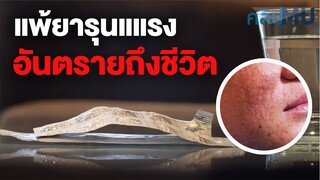 แพ้ยารุนแแรง อันตรายถึงชีวิต | คลิป MU [Mahidol Channel]