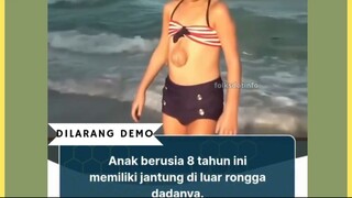 Seorang gadis kecil asal Rusia terlahir dengan kondisi langka yang membuat jantungnya berada di luar