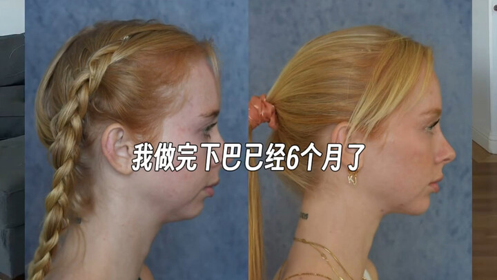 Cô gái trẻ đã phẫu thuật độn cằm vì cằm bị thụt vào.