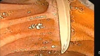 Một con giun đũa chui vào ống mật, hãy xem cách lấy nó ra như thế nào?