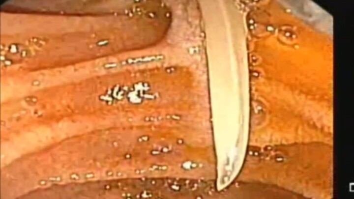 胆管钻进来一条蛔虫，看看如何取出来？