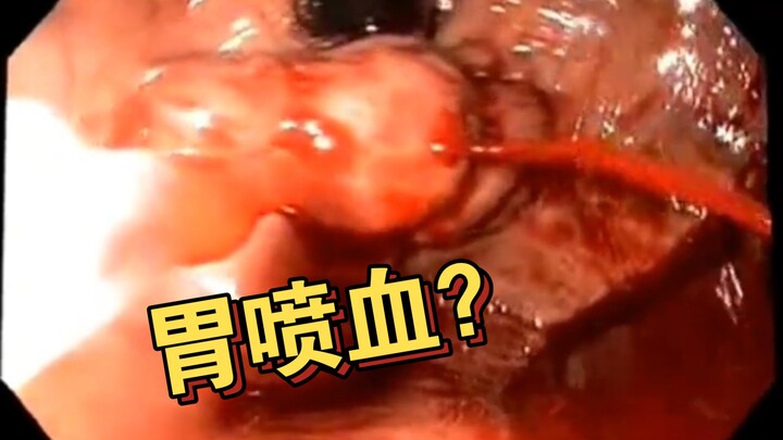 Endoscopic hemostasis after gastric bleeding