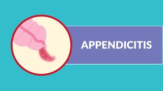 Appendicitis