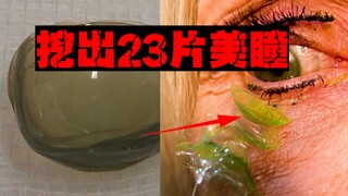 [Missing Lenses] A woman who wears one every day has it slipping into her eyelid without even realiz