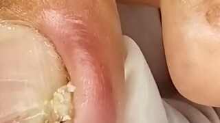 remove ingrown