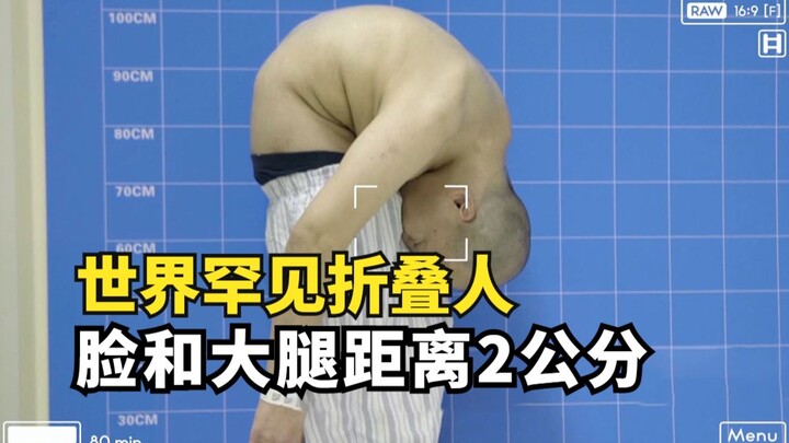 A rare folding person in the world, living with a 180-degree body bend for 11 years, face and thigh 