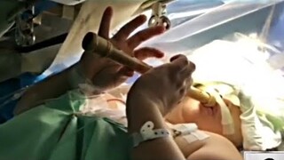 Guro, matagumpay na naoperahan sa utak habang tumutugtog ng FLUTE