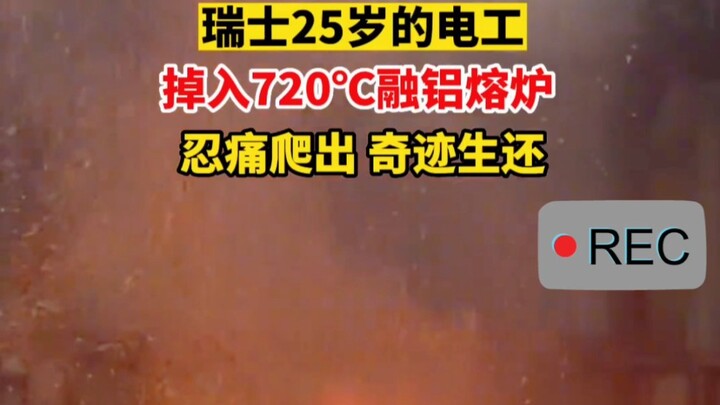 Thợ điện 25 tuổi người Thụy Sĩ rơi vào lò nung nhôm nóng chảy 720°C, cố gắng chịu đau bò ra và sống 