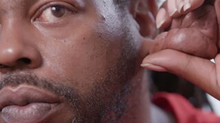 ผู้ชายคนนี้มีติ่งหูขนาดเท่ากำปั้น ไม่เจ็บแต่สร้างความลำบากอย่างมาก