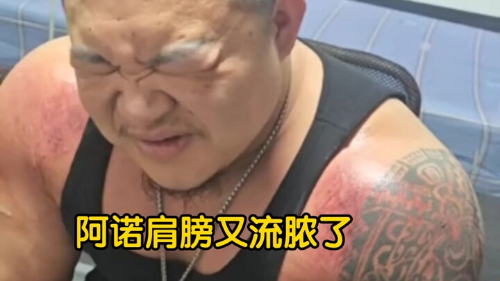 Changshu Anuo’s shoulder has flared up again, swollen and red—suspected to be caused by heavy traini