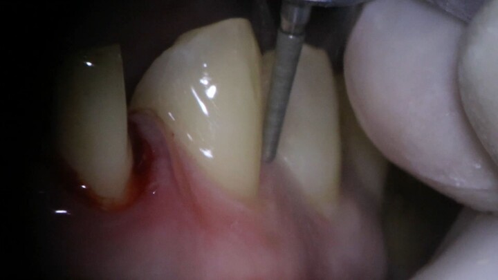 preparo dental