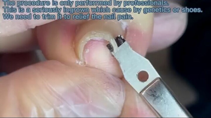 Pedicure Tutorial  How to treat Arched Toenail professionally._R