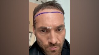 男子晒出自己植发四年的变化，这算是比较成功了吧