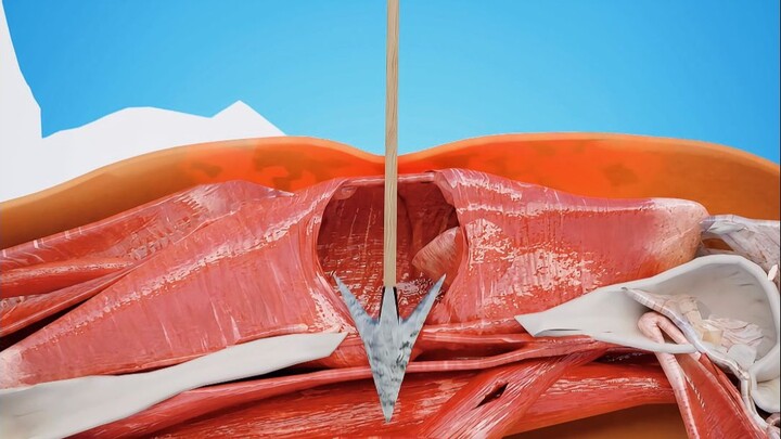 Apa? Langsung mencabut panah bisa menyebabkan cedera ulang!