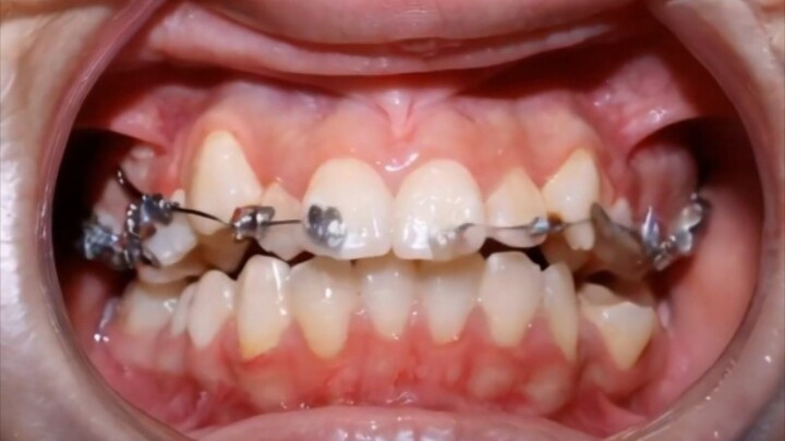 Perawatan gigi selama 24 bulan, lihat akhirnya seperti apa!