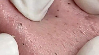 Relaksasi mendalam, saatnya menghilangkan komedo dan jerawat!