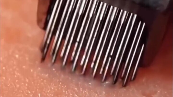 Inilah kenapa tato nggak akan pernah hilang.