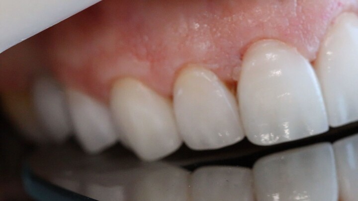 Lente de Contato Dental