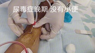 24 tahun, gagal ginjal stadium akhir, bertahan hidup berkat lengan ini,