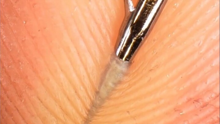 Why doesn't it hurt when a needle is stuck in my finger?