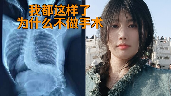 好多人问我为什么不手术？今天我来讲一下手术成功后的一部分，就算我手术成功了也没有任何一个医生能给我做全直，因为脊柱侧弯不部分手术成功后都不是直的，我重度脊柱侧弯