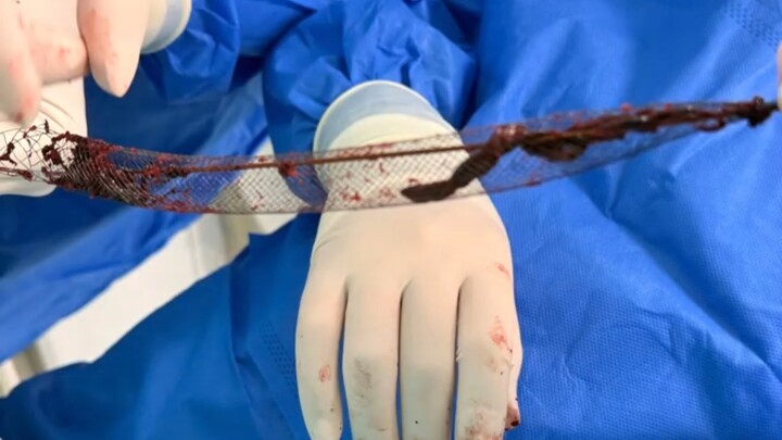 เพื่อนๆ เคยเห็นวิธีการดึงลิ่มเลือดในหลอดเลือดดำออกกันไหม? วิดีโอนี้มีภาพลิ่มเลือดจริงแสดงไว้ จึงได้ป