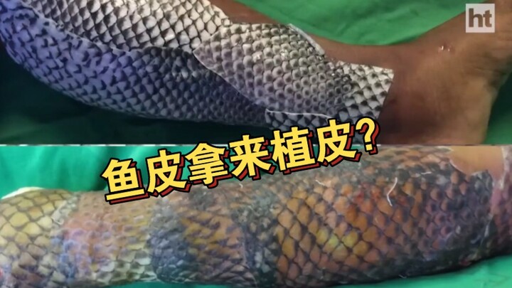 Using fish skin to repair burn wounds