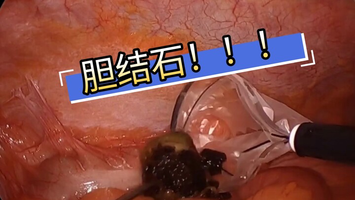 Gallstones causing intestinal obstruction