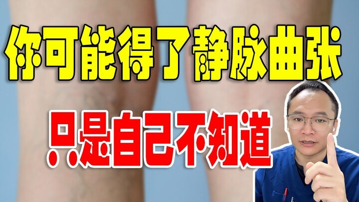 You might have varicose veins, but you just don’t know it.