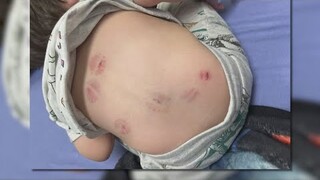 'How can you not notice eight bites?' Family alleges toddler's injuries occurred at day care