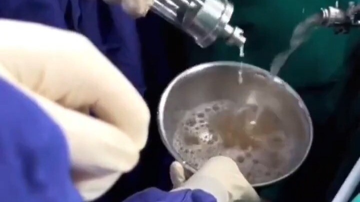 Flushing kidney stones...