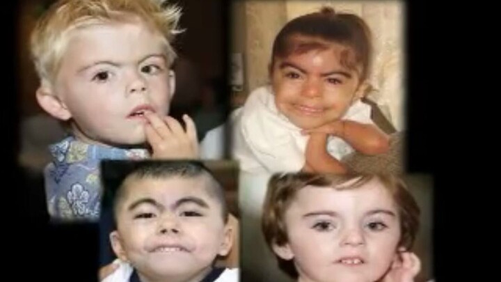 What Is Drange Syndrome, a Rare Disease in Children?