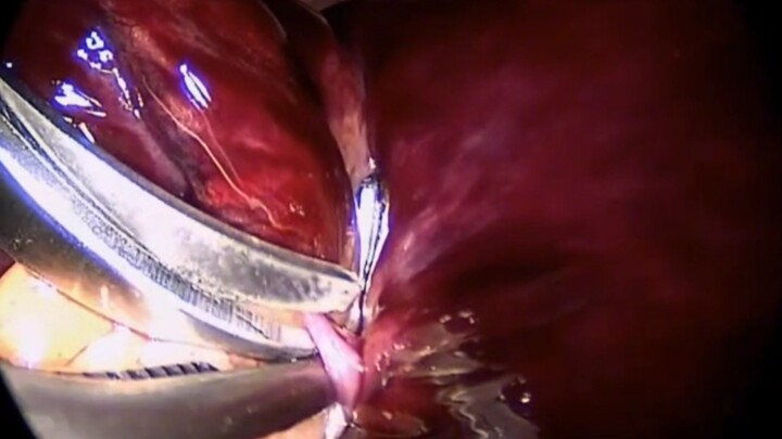 Management of Strangulated Bowel Obstruction