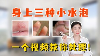 90% of people have experienced these three types of blisters—today, one video will teach you how to 