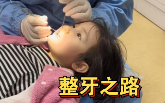 Hiệu quả sau nửa năm điều trị khớp cắn ngược ở trẻ em! Mong tất cả các bậc cha mẹ đừng bỏ qua chuyện