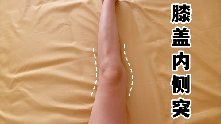 Inner Knee Bump? The Real Cause: If your lower-body strength, foot/ankle alignment, or force lines a