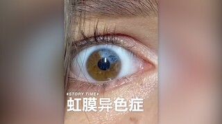 [Heterochromia Iridum] "لقد تعرضت للتنمر بسبب عيني لسنوات..."