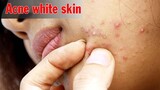 Acne & Pimples & Blackheads Remove | Điều Trị Mụn Ẩn Cho Bạn Nam Tuổi Dậy Thì - SacDepSpa #359