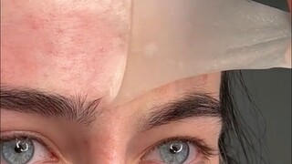 Haima International Media | An Immersive Acne Treatment Experience by an Overseas Beauty and Skincar