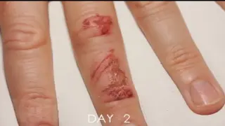 Timelapse Of A Wound Healing